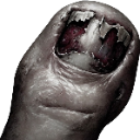 A close-up of a fleshy, mangled finger with a damaged, peeling nail against a black background.